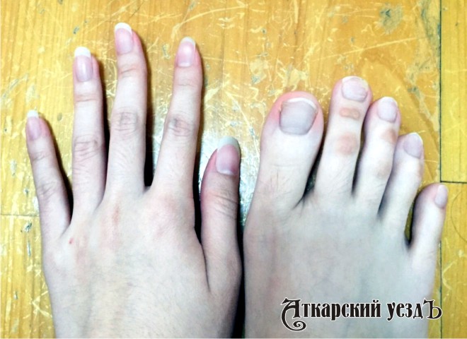 Некрасивые пальцы на ногах